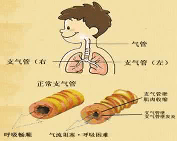 不打針不吃藥，負氧離子治療氣管炎好轉(zhuǎn)率達95%